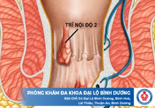 Nhận biết trĩ cấp độ 2