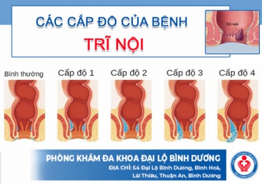 Trĩ nội có mấy cấp độ?