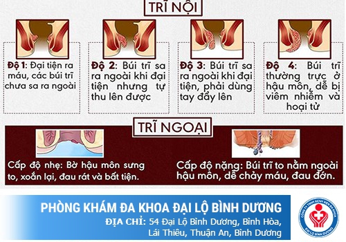 Khác nhau giữa trĩ nội và trĩ ngoại