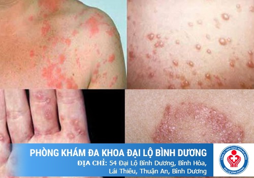 Dấu hiệu bệnh lậu ở nam và nữ giới 