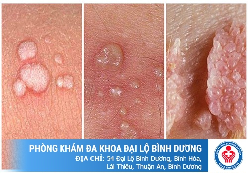 Đi massage có bị lây các bệnh xã hội không