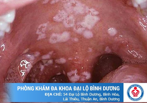 Dấu hiệu bệnh lậu ở nam giới 