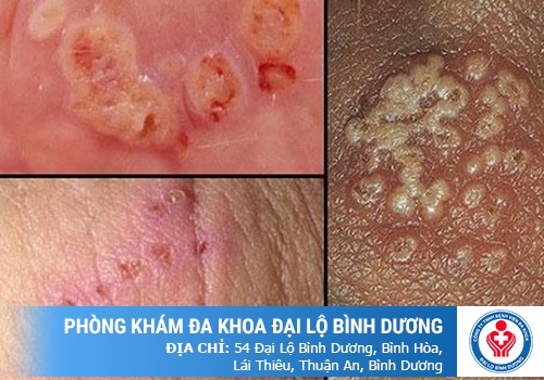 BỆNH LẬU CÓ DẪN ĐẾN VÔ SINH HAY KHÔNG