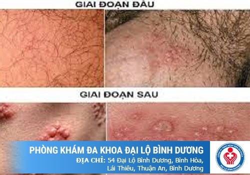 Chi phí điều trị bệnh mụn rộp sinh dục