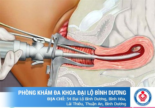 hút thai 6 tuần