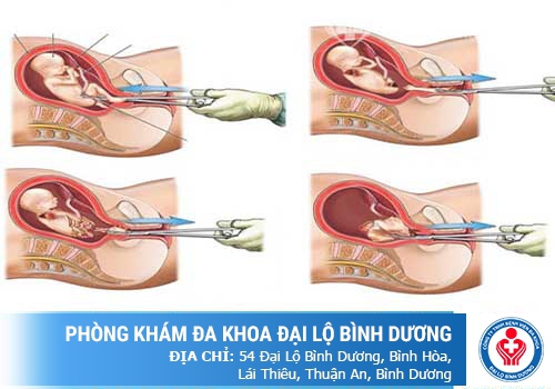 Phá thai 5 tuần tuổi có thực hiện được không bác sĩ