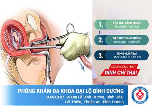 Phá thai an toàn, không đau bằng phương pháp LIFNO 