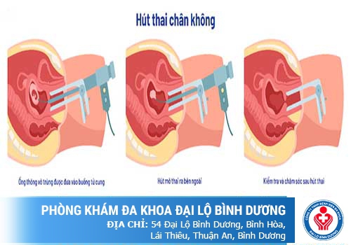 QUY TRÌNH THỰC HIỆN HÚT THAI