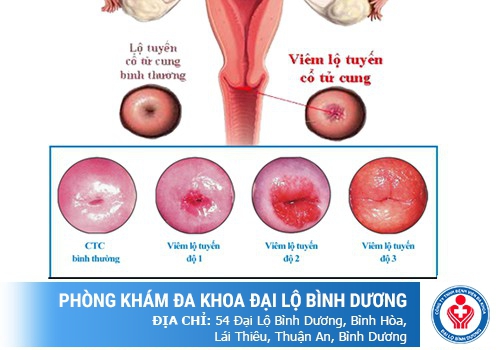Bệnh viêm lộ tuyến tử cung có 3 cấp độ bệnh khác nhau