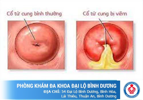 Viêm cổ tử cung ở nữ giới