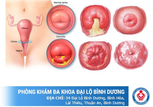 Tác hại của bệnh viêm lộ tuyến cổ tử cung
