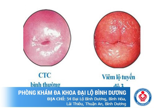 TRIỆU CHỨNG CỦA BỆNH VIÊM LỘ TUYẾN CỔ TỬ CUNG