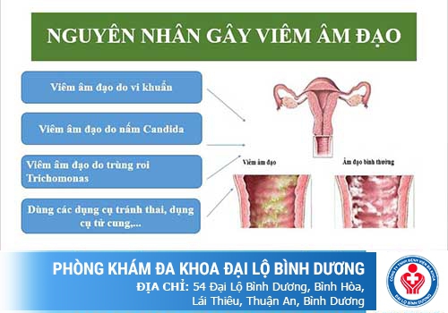 Các nguyên nhân hiệu quả gây viêm nấm âm đạo ở nữ giới